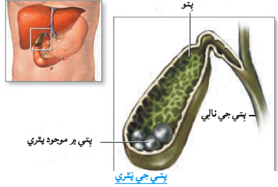 پتي جي پٿري جي تصوير
